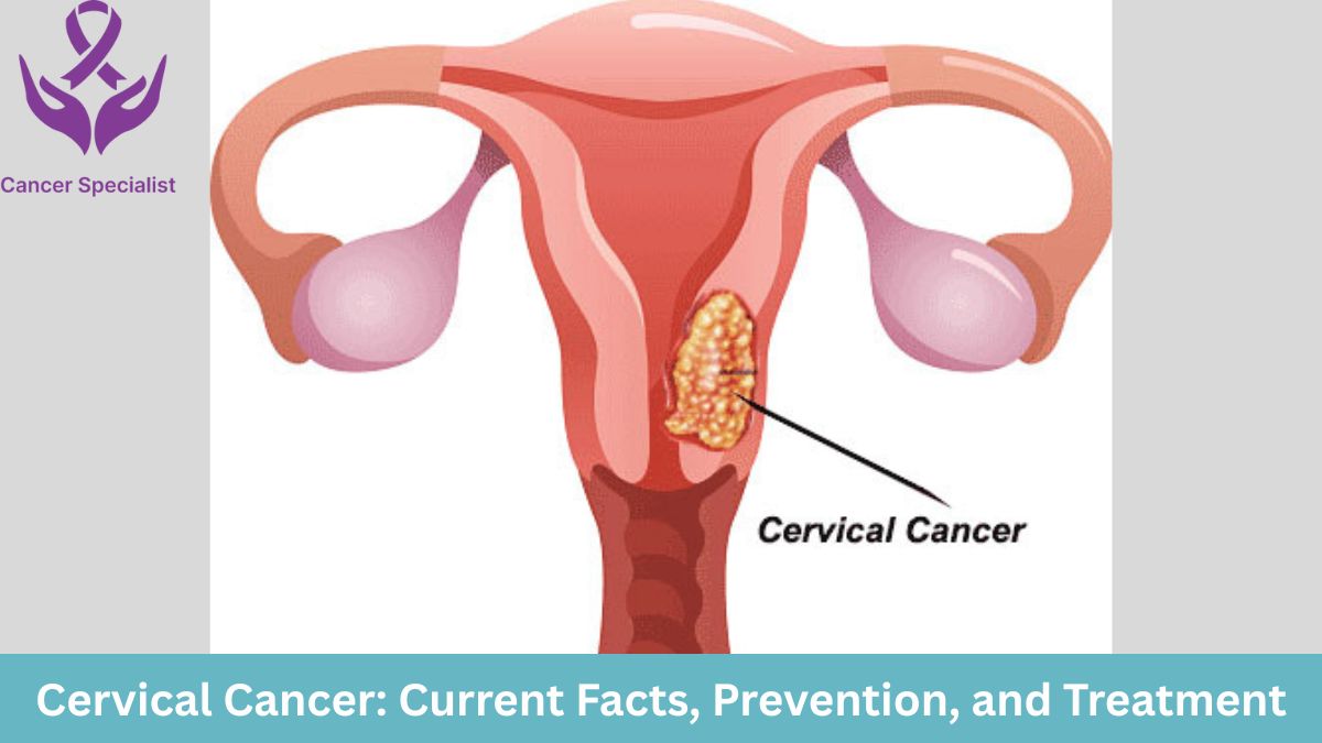 Cervical Cancer by Cancer Doctor