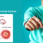 Cervical Cancer by Cancer Doctor