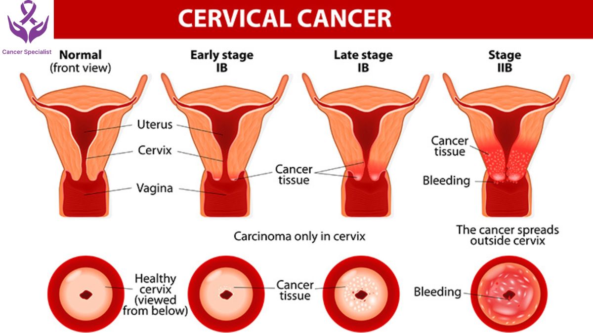 Cervical Cancer by Cancer Doctor
