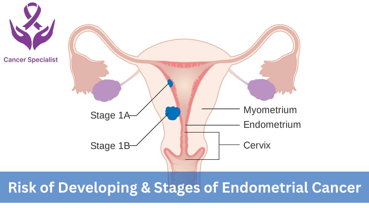 Endometrial Cancer-Dr Suyash Agrawal the Best Cancer Specialist In Indore