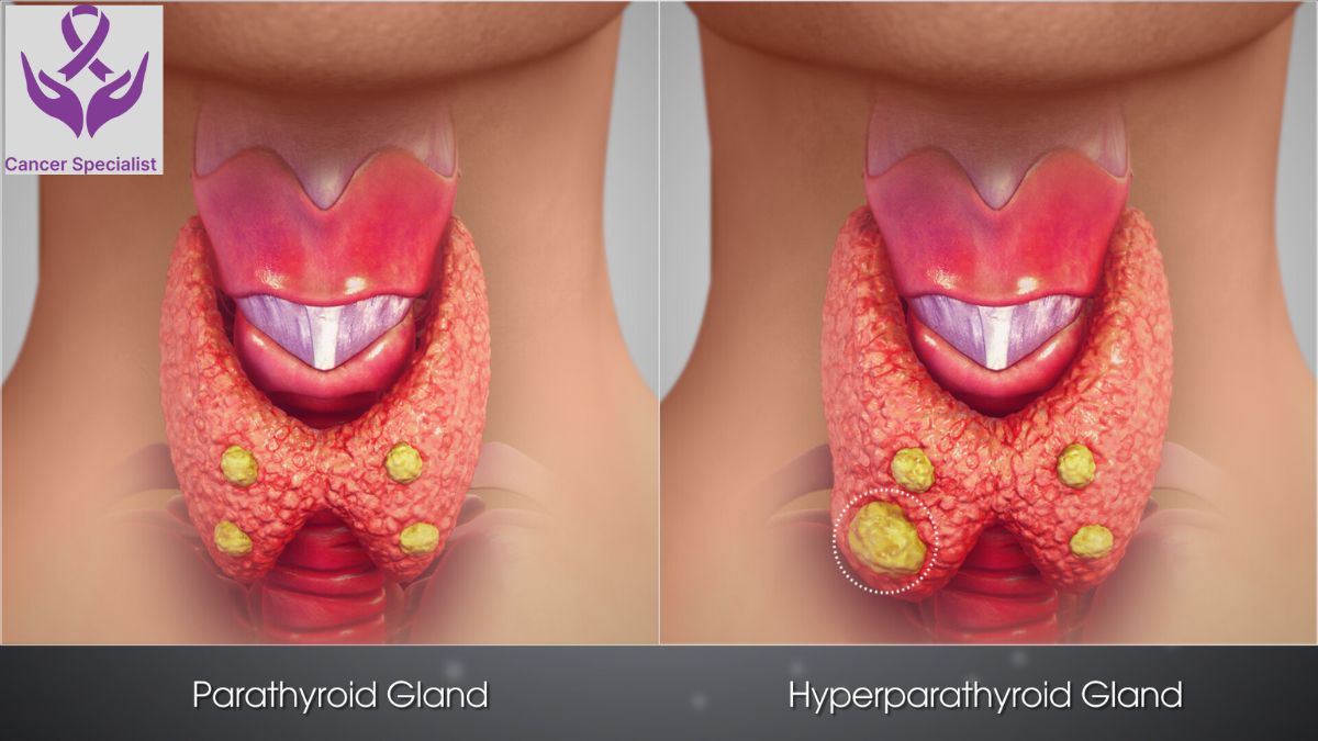 Parathyroid Cancer - Dr Suyash Agrawal - Best Cancer Surgeon In Indore