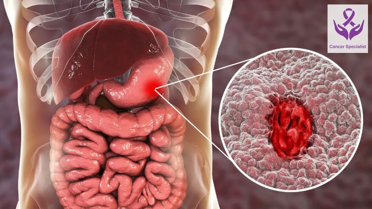 Gastrointestital cancer - Dr Suyash Agrawal - Best oncologist in indore
