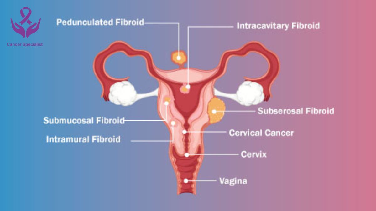 Gynecological Cancers - Dr Suyash Agrawal - Cancer Specialist