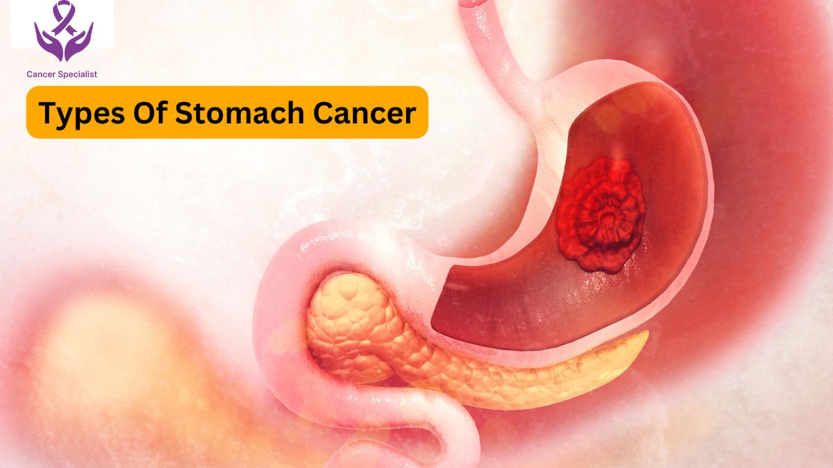 Gastro Intestinal Cancer - Dr Suyash Agrawal - Cancver Doctor