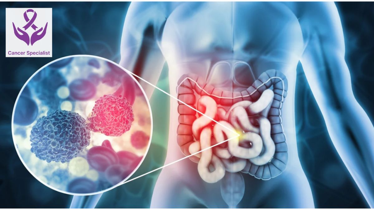 Gastro Intestinal Cancer by Dr Suyash Agrawal -- Cancer Doctor