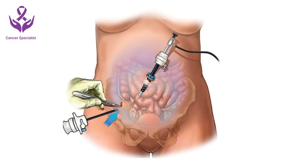 General Surgery - Dr Suyash Agrawal a best oncologist in indore