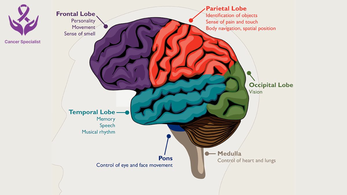 Brain Cancer Dr Suyash Agrawal Cancer Doctor Indore (1)