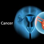 Ovarian Cancer Dr Suyash Agrawal Cancer Specialist