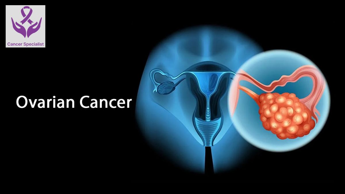 Ovarian Cancer Dr Suyash Agrawal Cancer Specialist