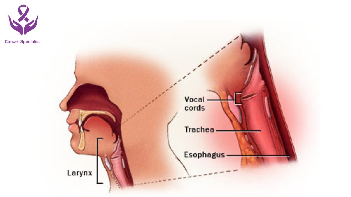 Throat Cancer by Dr Suyash Agrawal a Best Cancer Surgeon In Indore