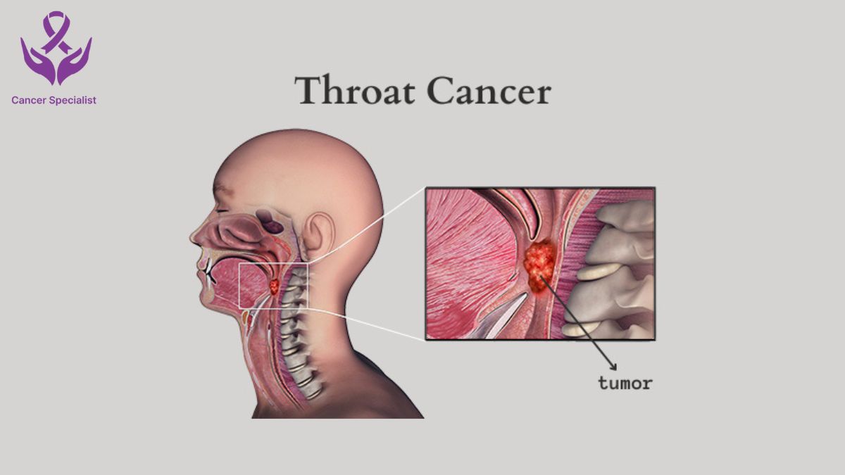 throat-cancer - Dr Suyash Agrawal - Best cancer Surgeon In Indore