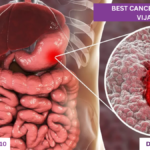 best cancer specialist in Vijayanagar Indore